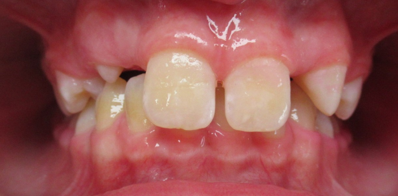 disjoncteur maxillaire mandelieu la napoule stabilite Cas clinique Dr Mathelin Christel | Orthodontiste Mandelieu-la-Napoule