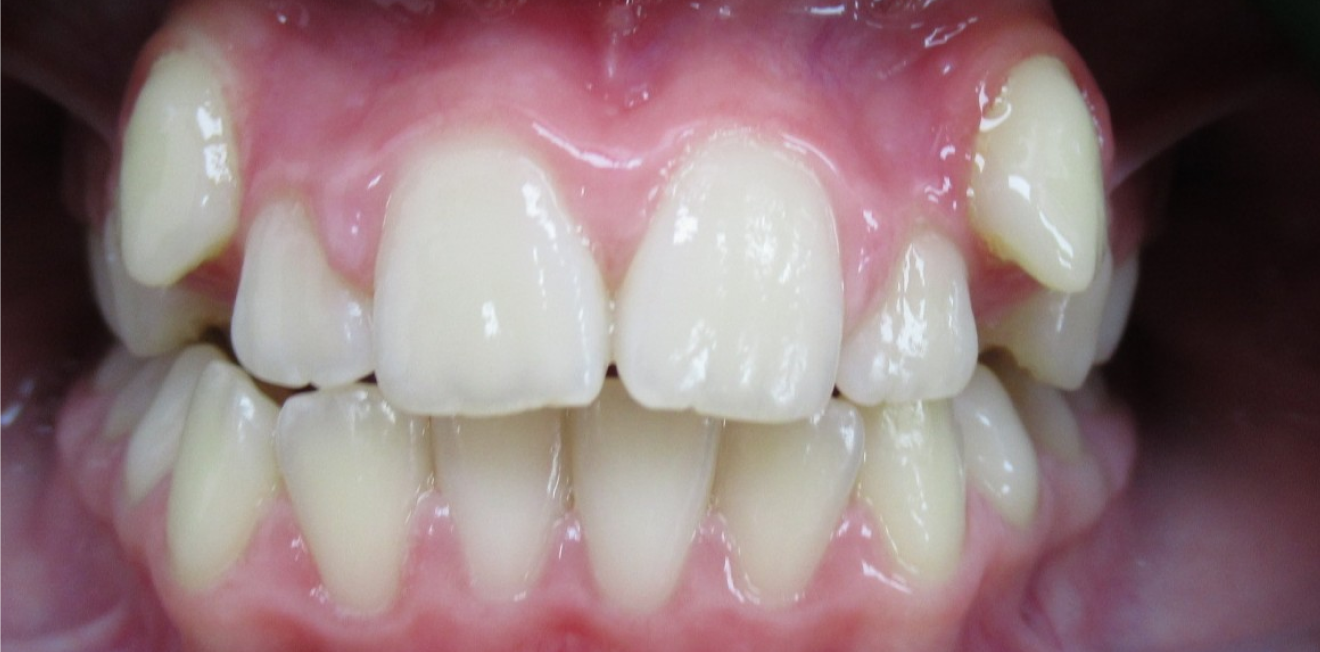 dr mathelin christel mandelieu la napoule alignement Cas clinique Dr Mathelin Christel | Orthodontiste Mandelieu-la-Napoule