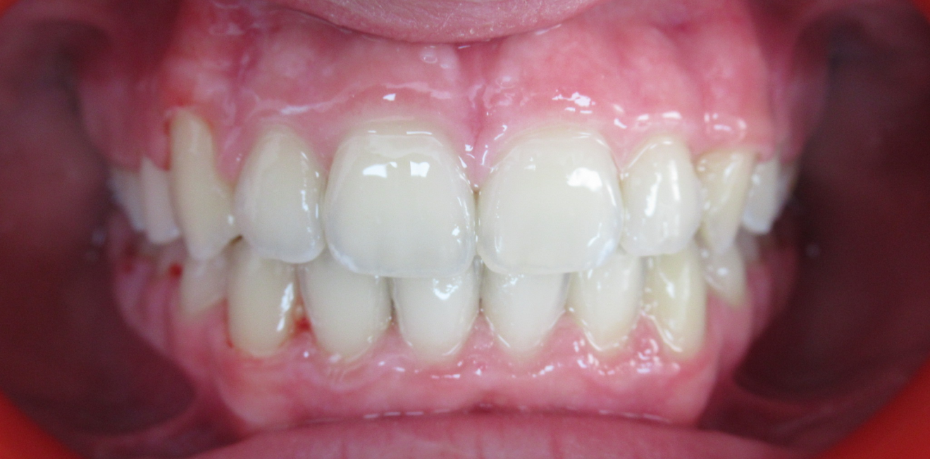 dr mathelin christel mandelieu la napoule bagues Cas clinique Dr Mathelin Christel | Orthodontiste Mandelieu-la-Napoule