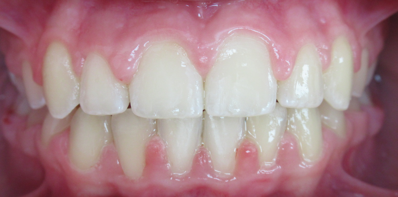 dr mathelin christel mandelieu la napoule orthodontie Cas clinique Dr Mathelin Christel | Orthodontiste Mandelieu-la-Napoule