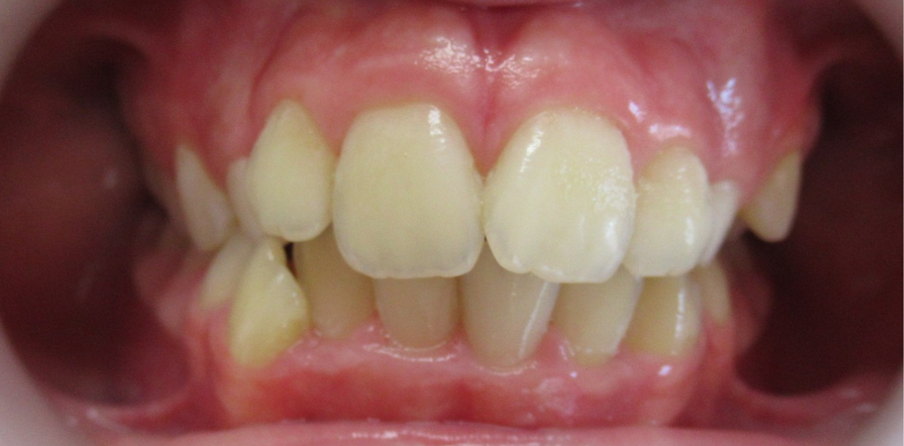 dr mathelin christel mandelieu la napoule sourire Cas clinique Dr Mathelin Christel | Orthodontiste Mandelieu-la-Napoule