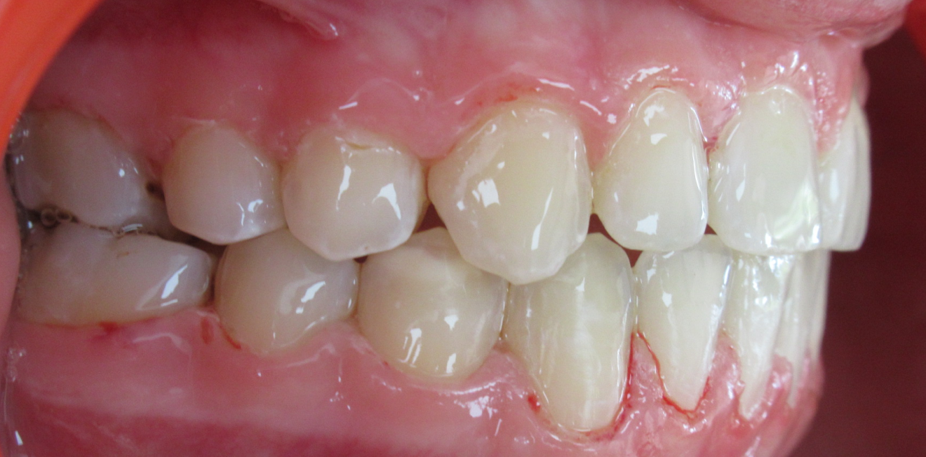 dr mathelin christel mandelieu la napoule traitement Cas clinique Dr Mathelin Christel | Orthodontiste Mandelieu-la-Napoule