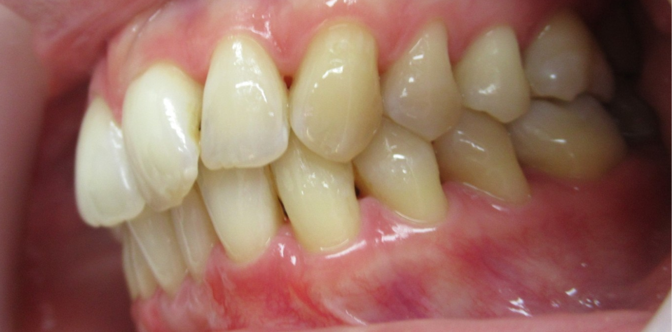 dumont_gouttieres_7_1_1