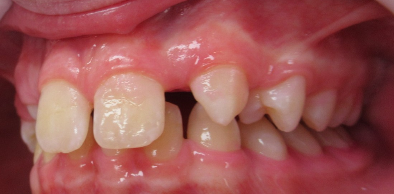 educateur fonctionnel mandelieu la napoule correction Cas clinique Dr Mathelin Christel | Orthodontiste Mandelieu-la-Napoule