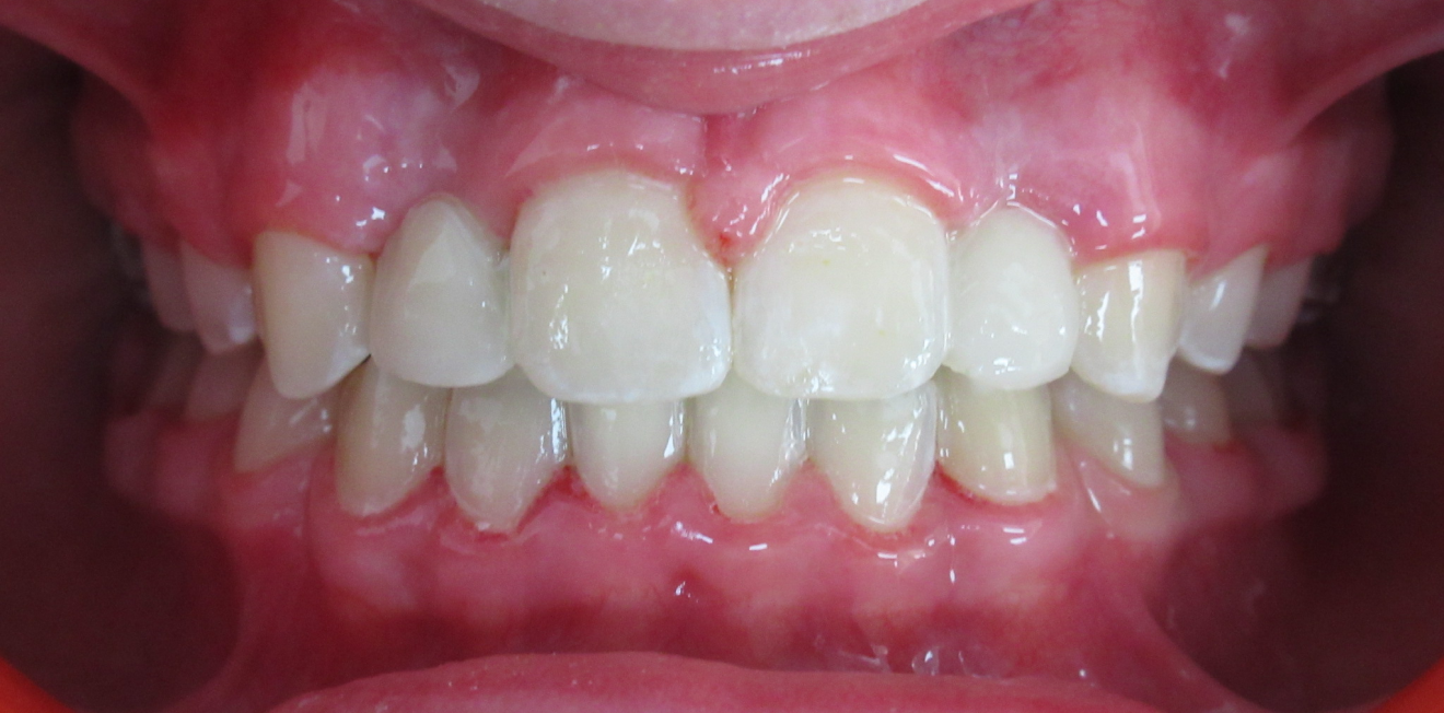 educateur fonctionnel mandelieu la napoule croissance Cas clinique Dr Mathelin Christel | Orthodontiste Mandelieu-la-Napoule