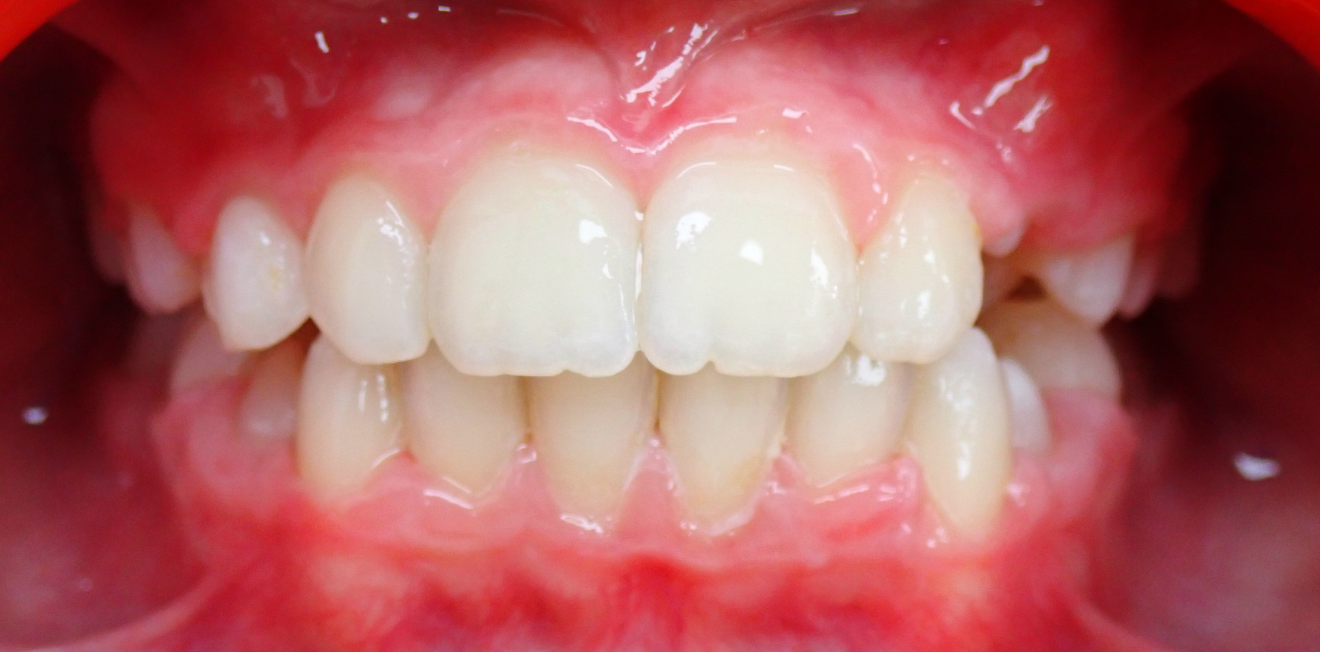 educateur fonctionnel mandelieu la napoule posture Cas clinique Dr Mathelin Christel | Orthodontiste Mandelieu-la-Napoule