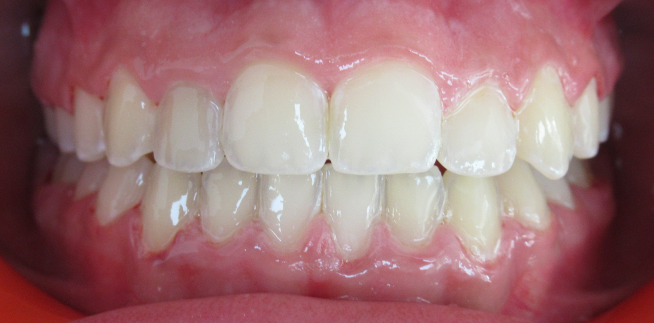 el_khattari_disjoncetur_bagues_6_1_1