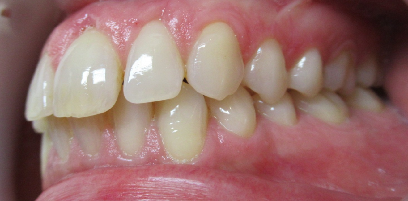 gerber_gouttieres_7_1