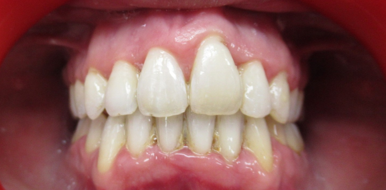 gouttieres transparentes mandelieu la napoule alignement Cas clinique Dr Mathelin Christel | Orthodontiste Mandelieu-la-Napoule