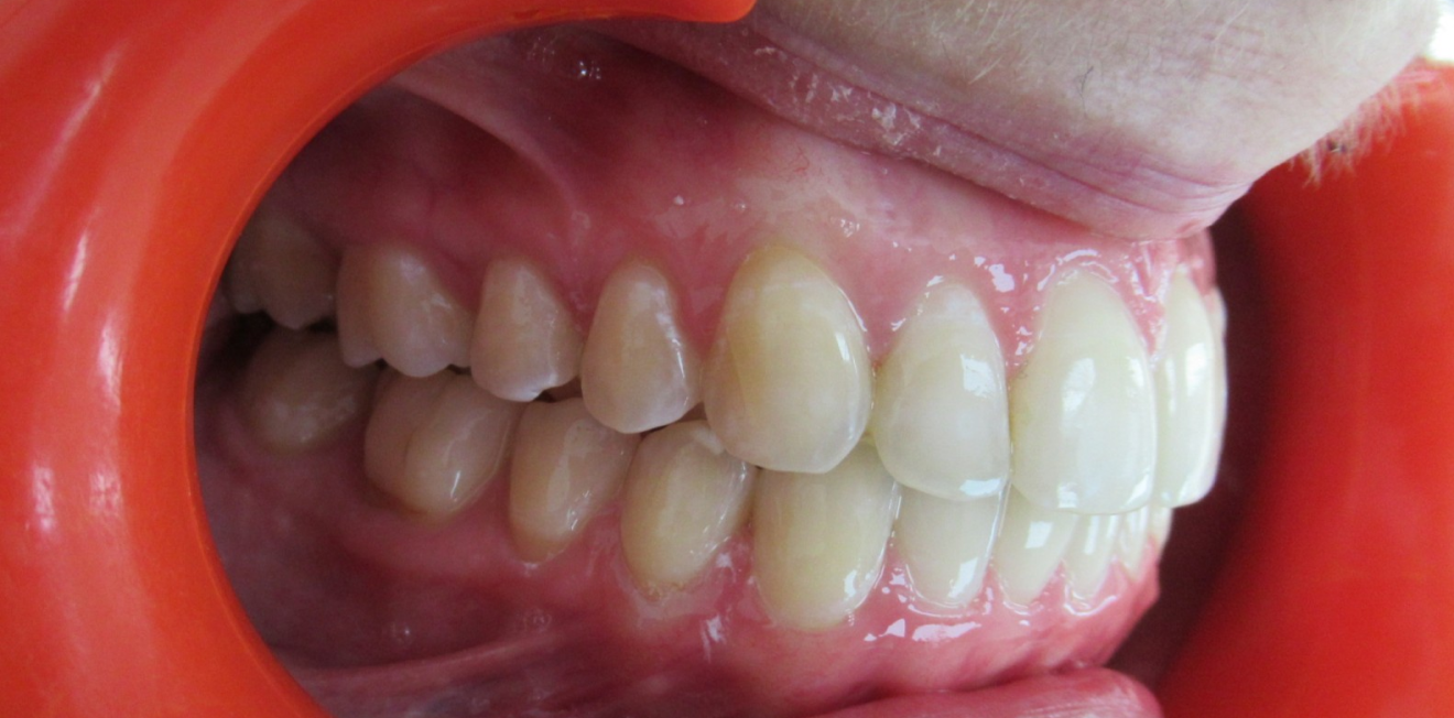gouttieres transparentes mandelieu la napoule correction Cas clinique Dr Mathelin Christel | Orthodontiste Mandelieu-la-Napoule