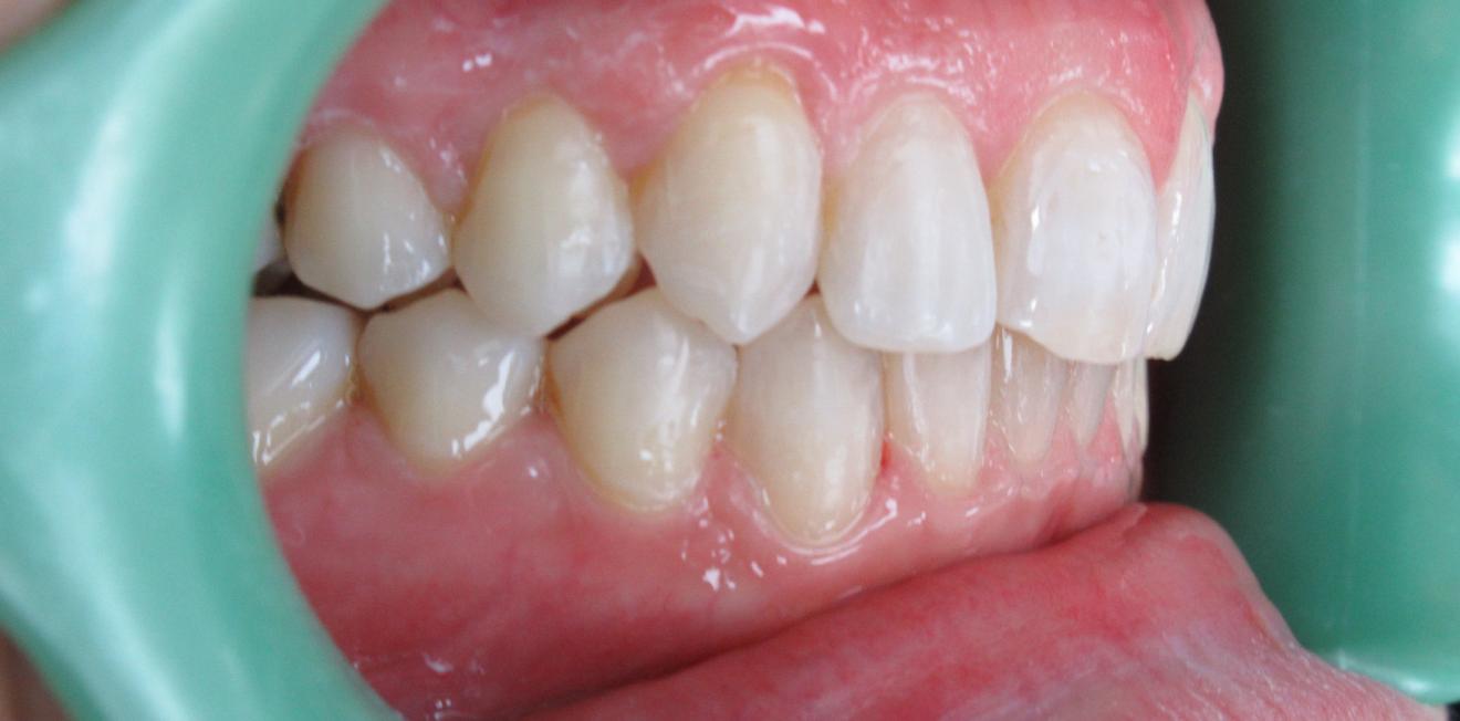 gouttieres transparentes mandelieu la napoule precision Cas clinique Dr Mathelin Christel | Orthodontiste Mandelieu-la-Napoule
