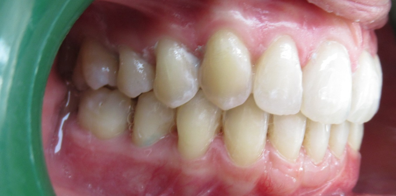 gouttieres transparentes mandelieu la napoule solution Cas clinique Dr Mathelin Christel | Orthodontiste Mandelieu-la-Napoule