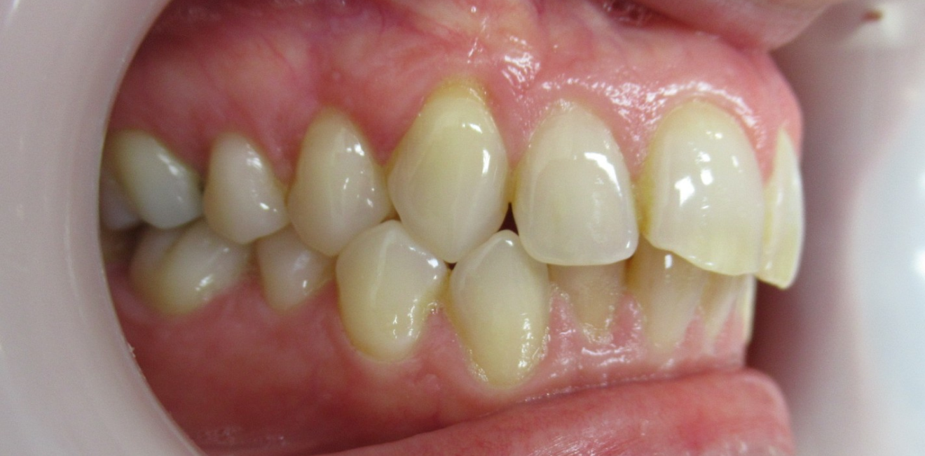 gouttieres transparentes mandelieu la napoule sourire Cas clinique Dr Mathelin Christel | Orthodontiste Mandelieu-la-Napoule