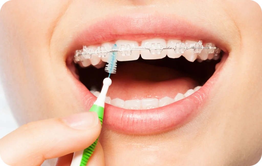 hygiene bucco dentaire mandelieu la napoule appareil Hygiène avec un appareil dentaire Dr Mathelin Christel | Orthodontiste Mandelieu-la-Napoule