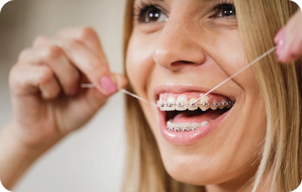 hygiene bucco dentaire mandelieu la napoule orthodontie Hygiène avec un appareil dentaire Dr Mathelin Christel | Orthodontiste Mandelieu-la-Napoule