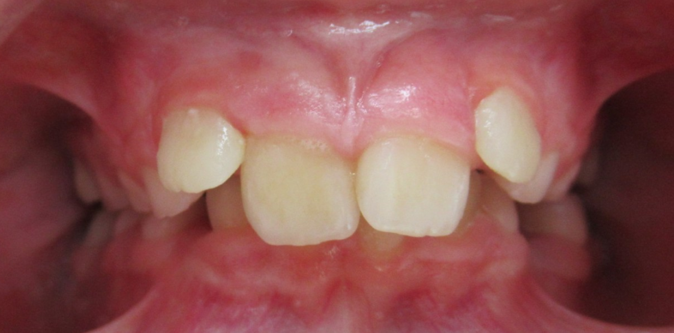 interceptive mandelieu la napoule alignement Cas clinique Dr Mathelin Christel | Orthodontiste Mandelieu-la-Napoule