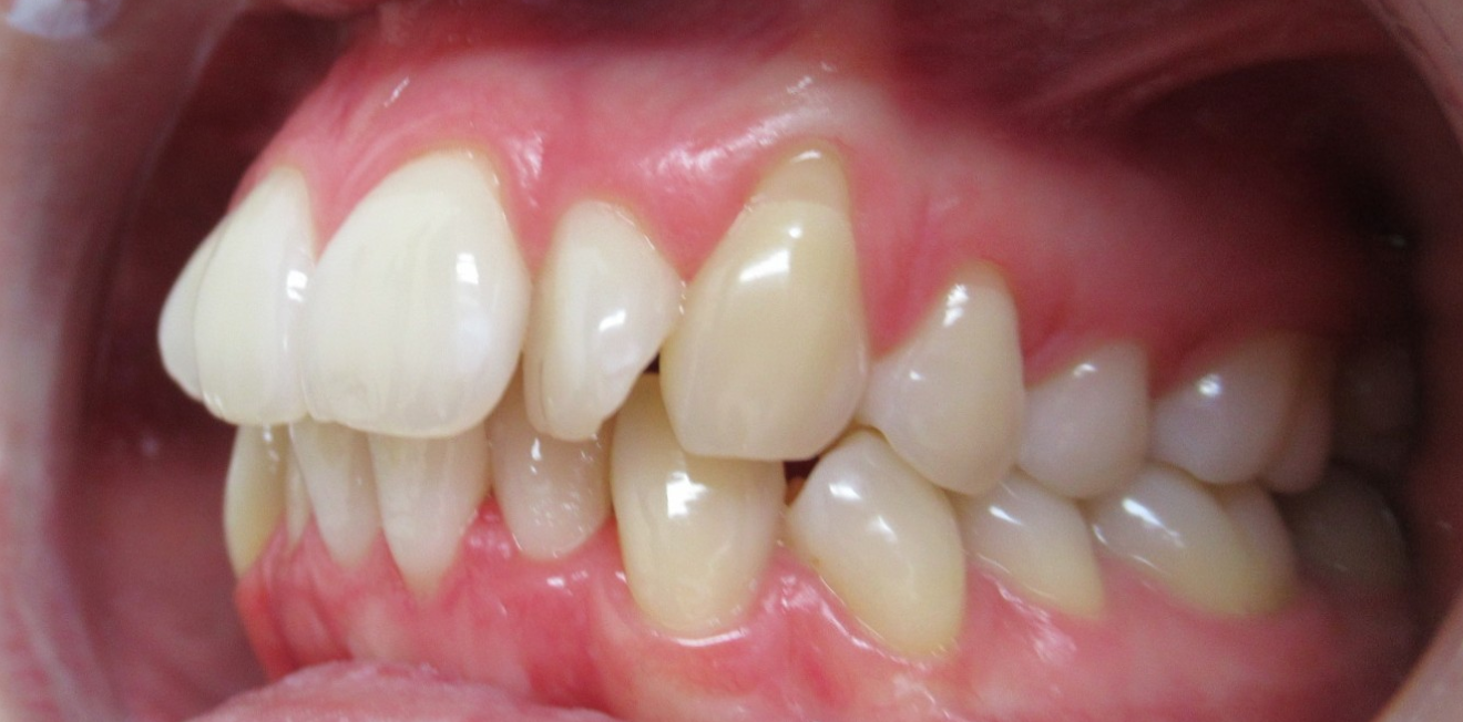 jaspart_gouttieres_6_1