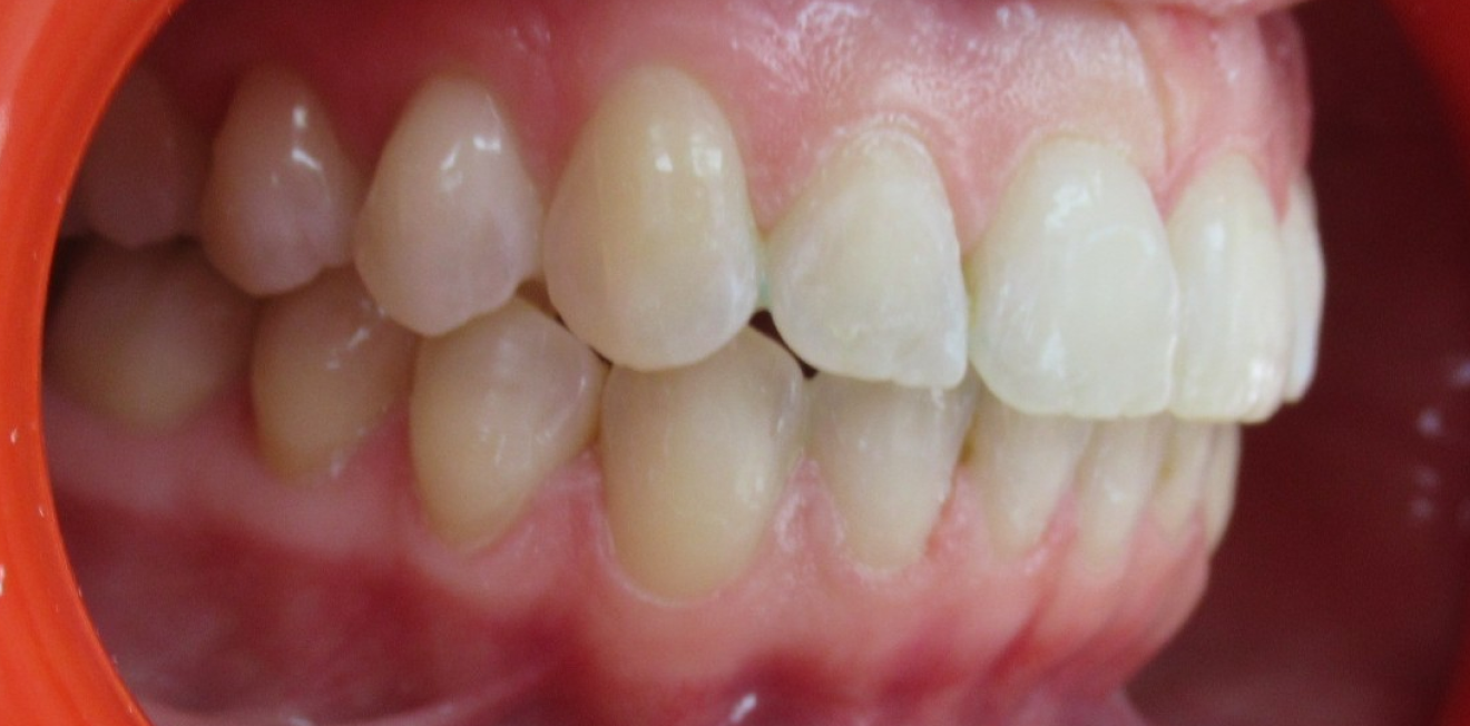 machoire arriere mandelieu la napoule correction Cas clinique Dr Mathelin Christel | Orthodontiste Mandelieu-la-Napoule