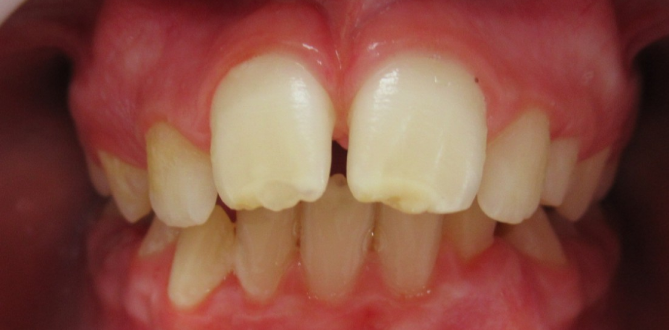 machoire arriere mandelieu la napoule traitement Cas clinique Dr Mathelin Christel | Orthodontiste Mandelieu-la-Napoule