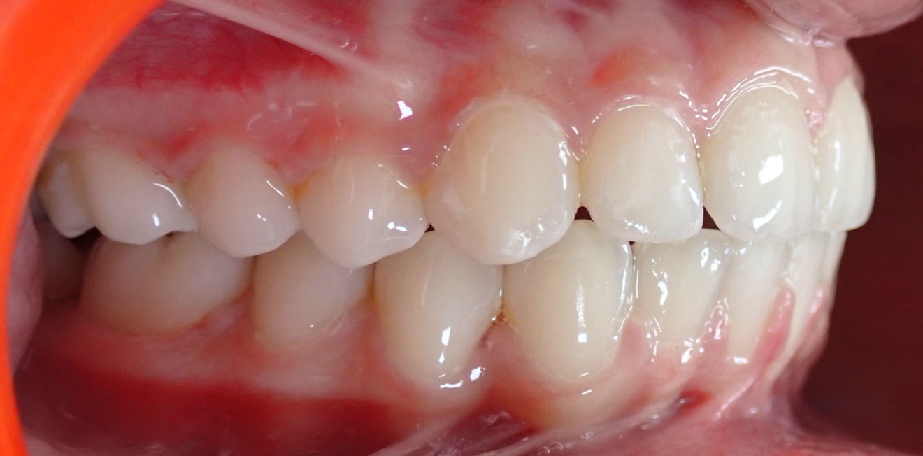 orthodontie adultes mandelieu la napoule alignement Cas clinique Dr Mathelin Christel | Orthodontiste Mandelieu-la-Napoule