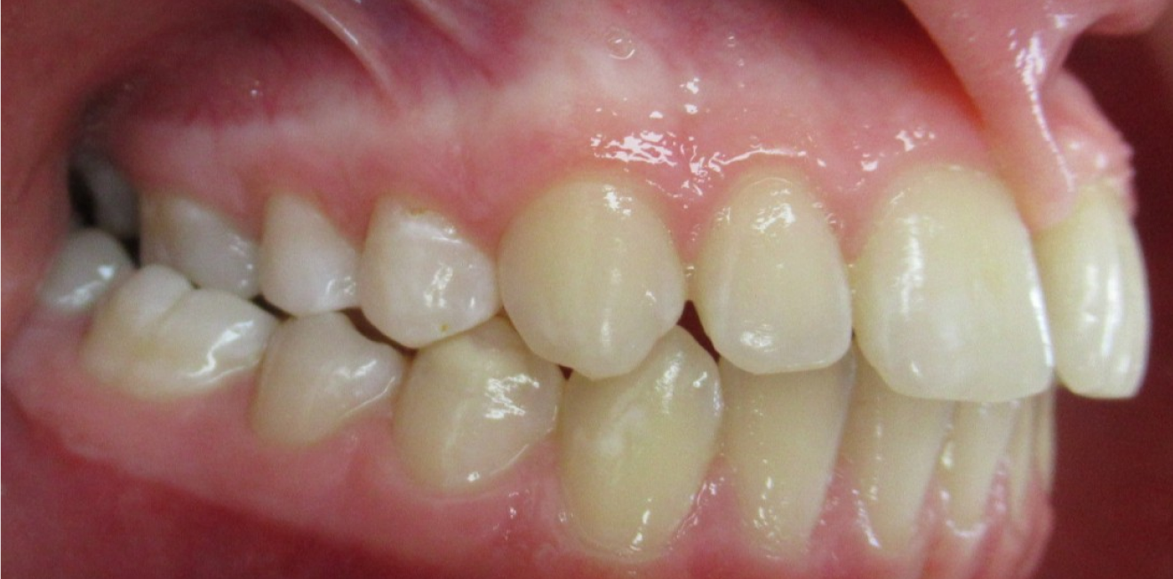 orthodontie adultes mandelieu la napoule discretion Cas clinique Dr Mathelin Christel | Orthodontiste Mandelieu-la-Napoule