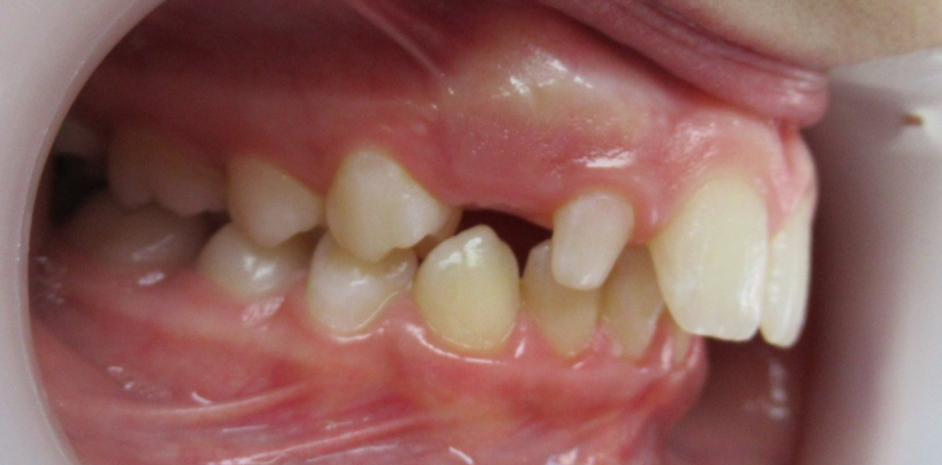 orthodontie adultes mandelieu la napoule esthetique Cas clinique Dr Mathelin Christel | Orthodontiste Mandelieu-la-Napoule