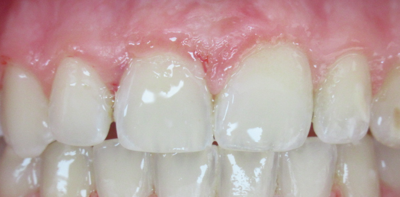 orthodontie adultes mandelieu la napoule solutions Cas clinique Dr Mathelin Christel | Orthodontiste Mandelieu-la-Napoule