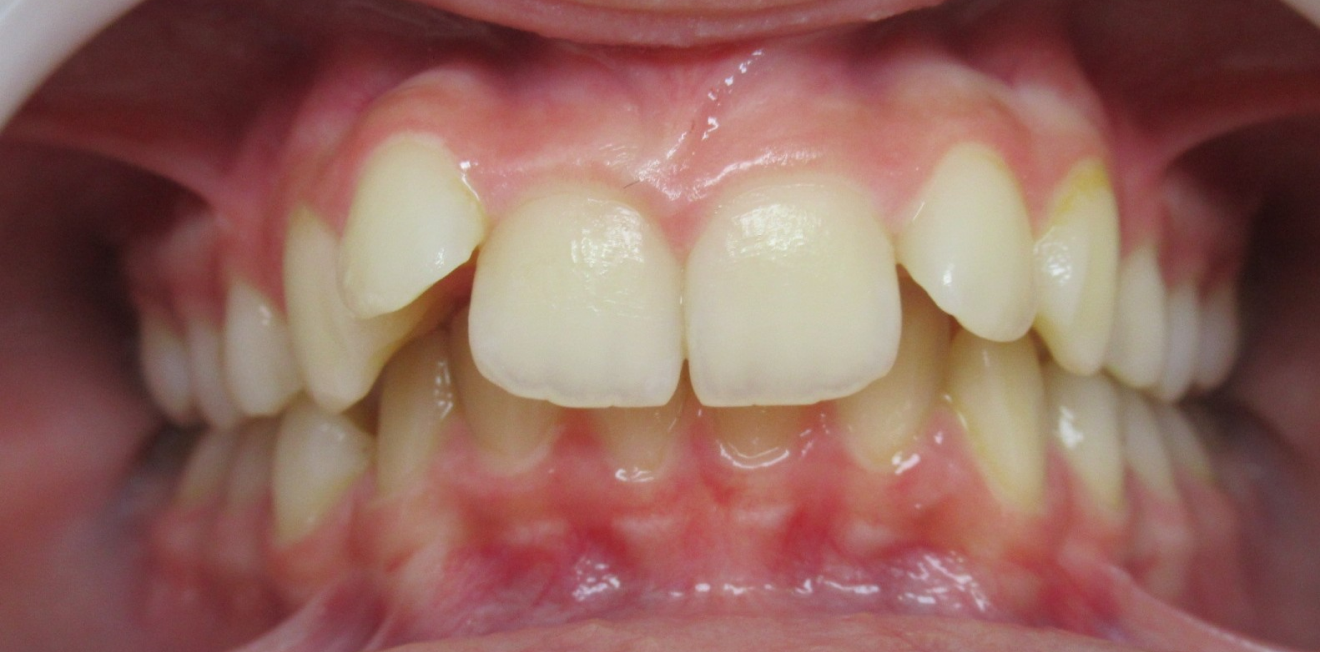 orthodontie adultes mandelieu la napoule solutions Cas clinique Dr Mathelin Christel | Orthodontiste Mandelieu-la-Napoule