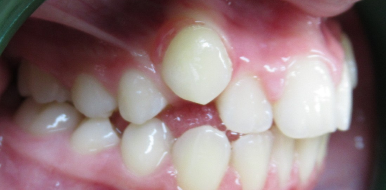 orthodontie adultes mandelieu la napoule sourire Cas clinique Dr Mathelin Christel | Orthodontiste Mandelieu-la-Napoule