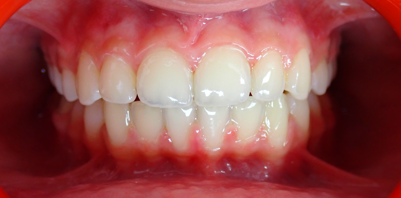 orthodontie adultes mandelieu la napoule sourire Cas clinique Dr Mathelin Christel | Orthodontiste Mandelieu-la-Napoule