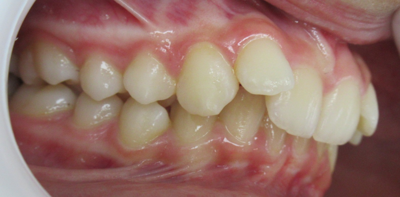 orthodontie adultes mandelieu la napoule traitement Cas clinique Dr Mathelin Christel | Orthodontiste Mandelieu-la-Napoule