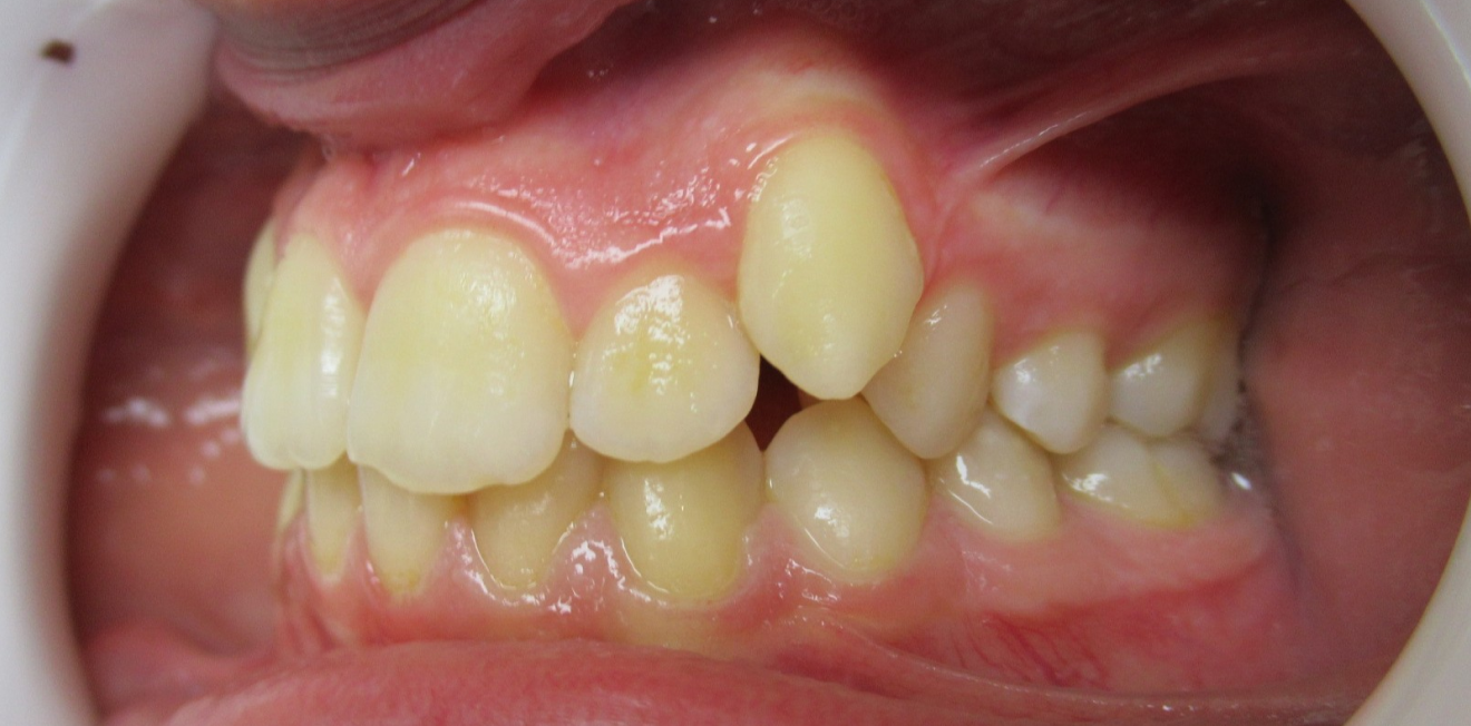 orthodontie enfants mandelieu la napoule bagues Cas clinique Dr Mathelin Christel | Orthodontiste Mandelieu-la-Napoule