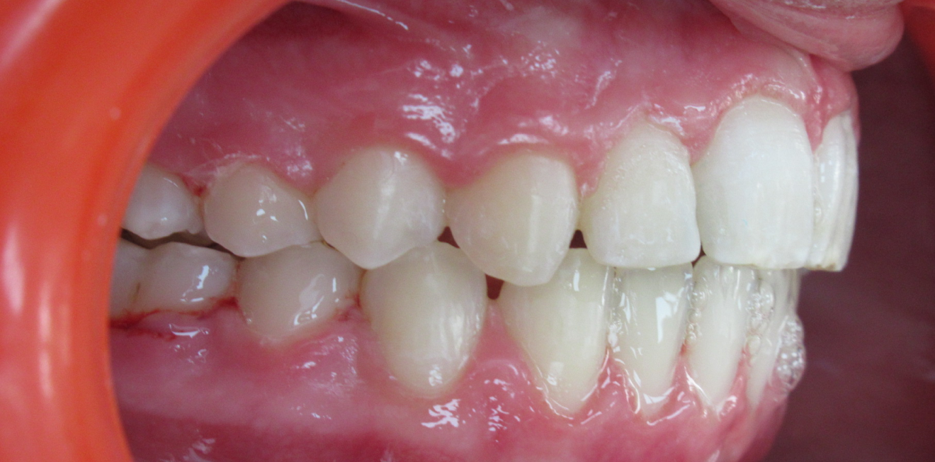 orthodontie enfants mandelieu la napoule correction Cas clinique Dr Mathelin Christel | Orthodontiste Mandelieu-la-Napoule