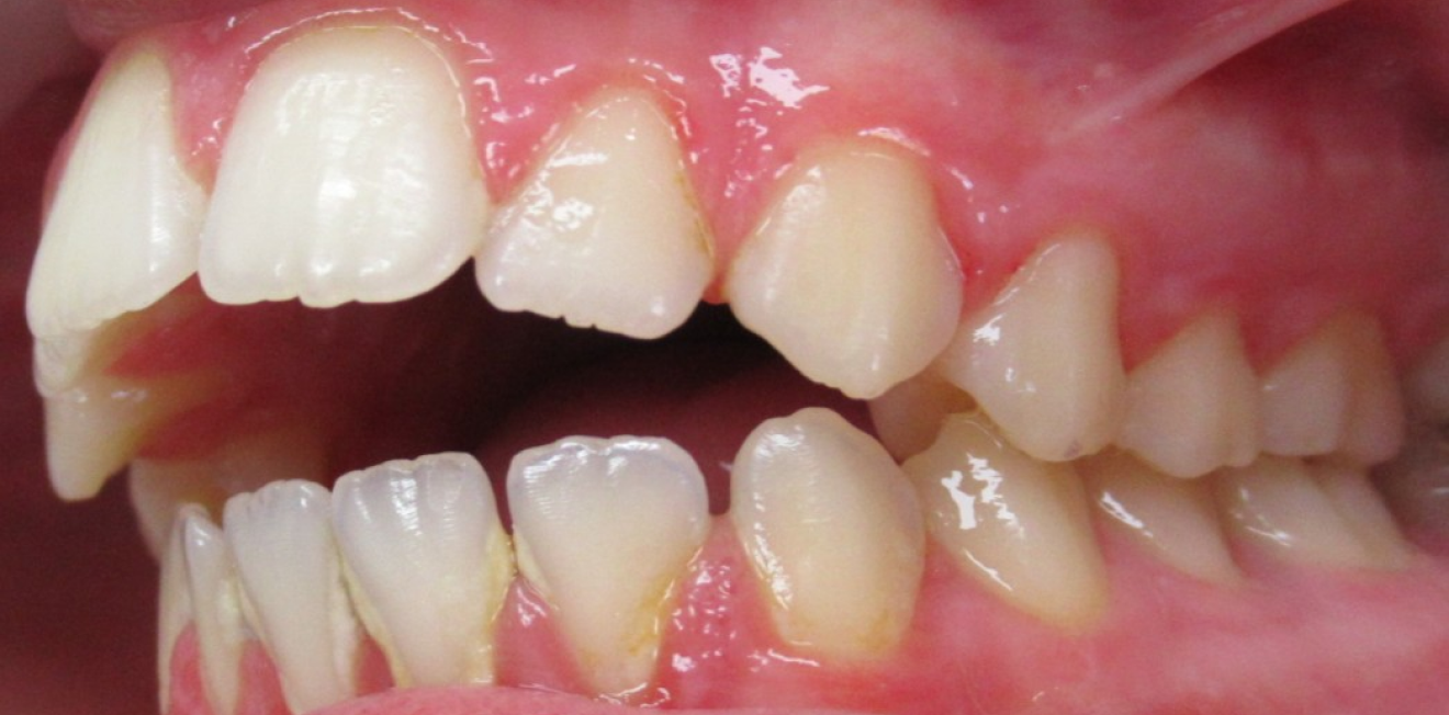 orthodontie enfants mandelieu la napoule croissance Cas clinique Dr Mathelin Christel | Orthodontiste Mandelieu-la-Napoule