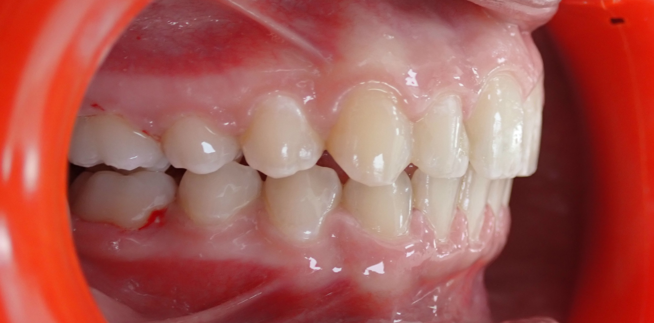 orthodontie enfants mandelieu la napoule equilibre Cas clinique Dr Mathelin Christel | Orthodontiste Mandelieu-la-Napoule