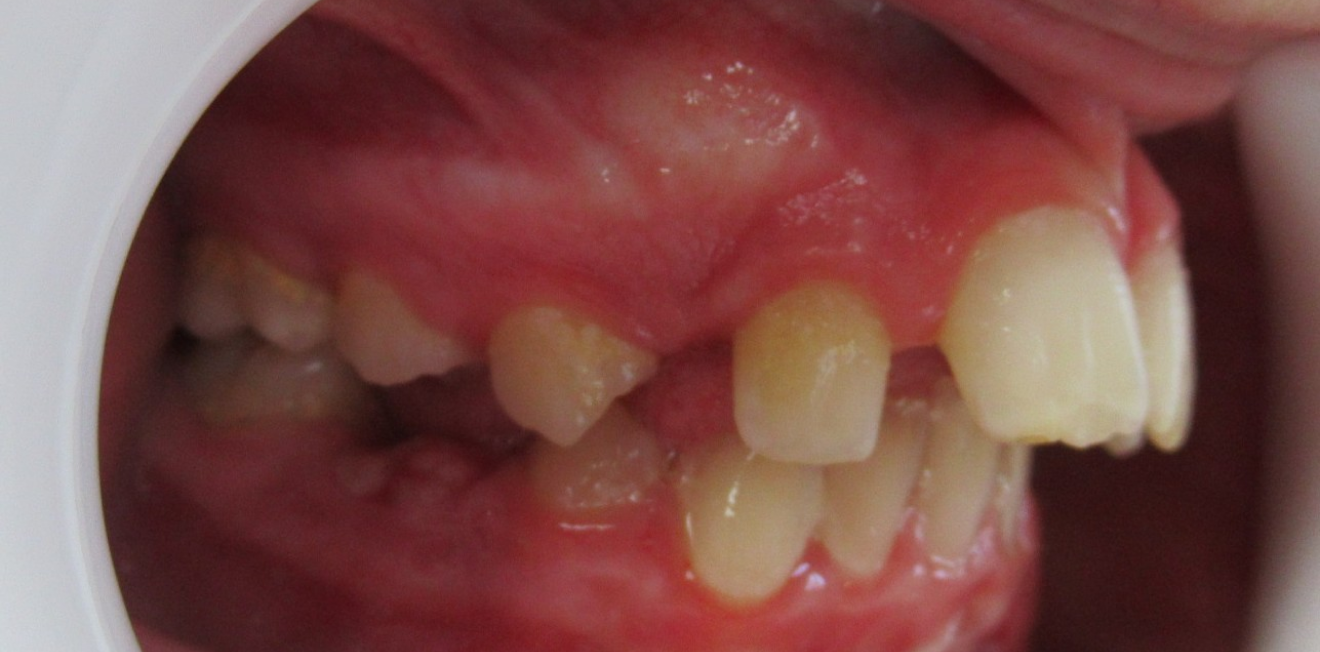 orthodontie enfants mandelieu la napoule prevention Cas clinique Dr Mathelin Christel | Orthodontiste Mandelieu-la-Napoule