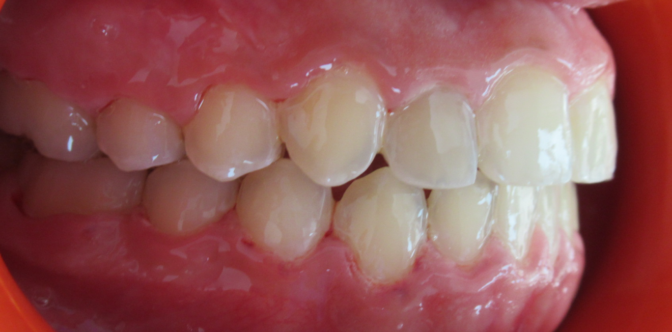 orthodontie interceptive mandelieu la napoule alignement Cas clinique Dr Mathelin Christel | Orthodontiste Mandelieu-la-Napoule