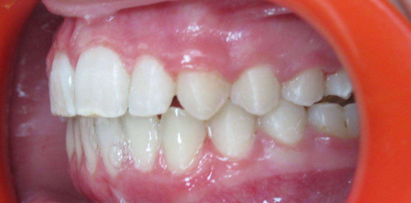 orthodontie interceptive mandelieu la napoule correction Cas clinique Dr Mathelin Christel | Orthodontiste Mandelieu-la-Napoule