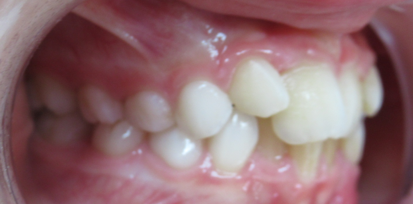 orthodontie interceptive mandelieu la napoule developpement Cas clinique Dr Mathelin Christel | Orthodontiste Mandelieu-la-Napoule