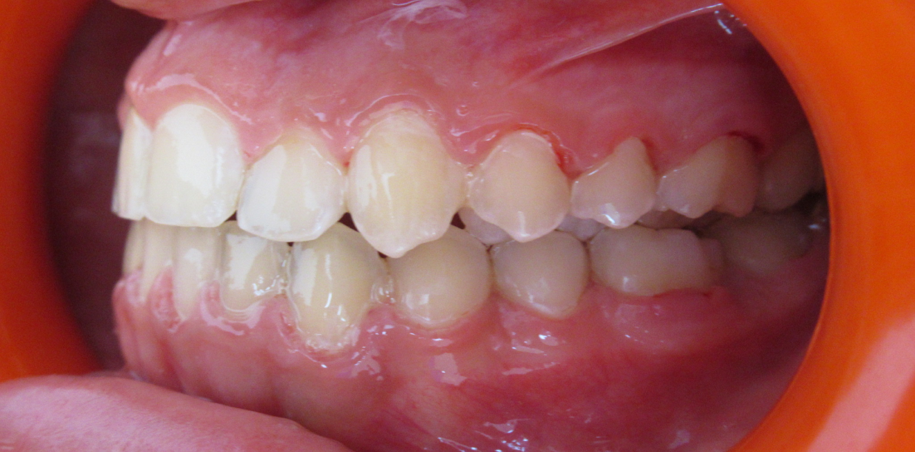 orthodontie interceptive mandelieu la napoule disjoncetur Cas clinique Dr Mathelin Christel | Orthodontiste Mandelieu-la-Napoule