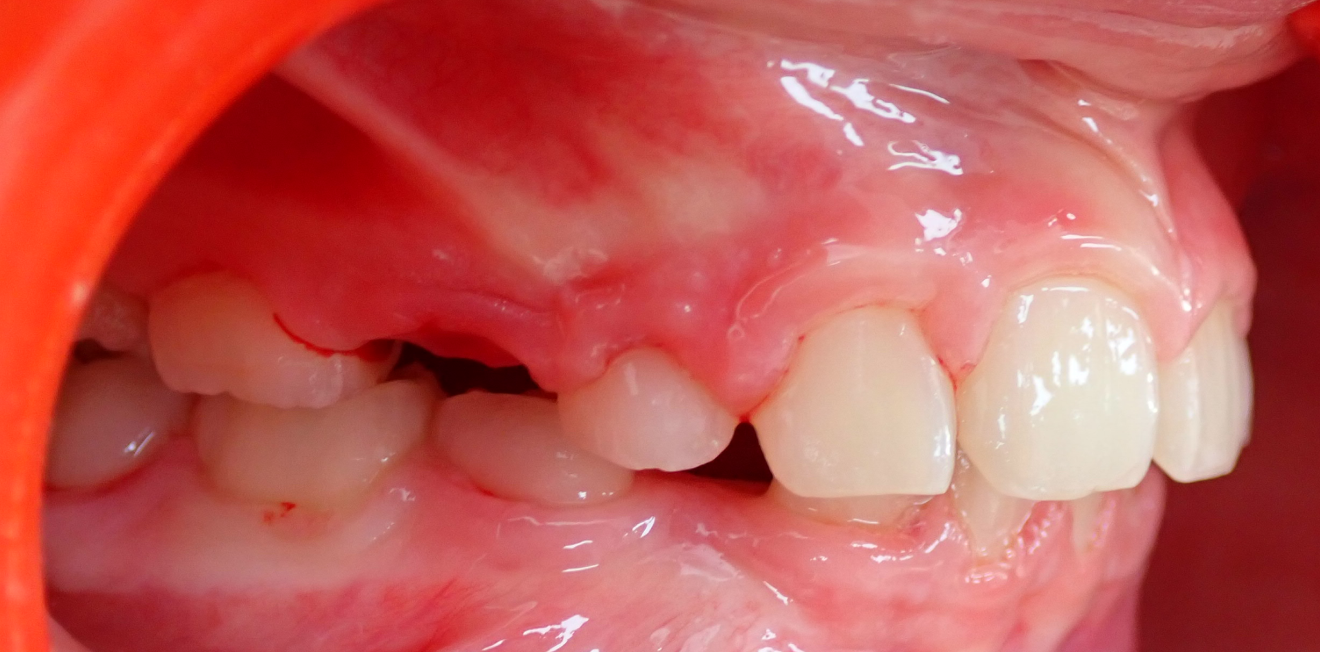 orthodontie interceptive mandelieu la napoule dr matheiln Cas clinique Dr Mathelin Christel | Orthodontiste Mandelieu-la-Napoule