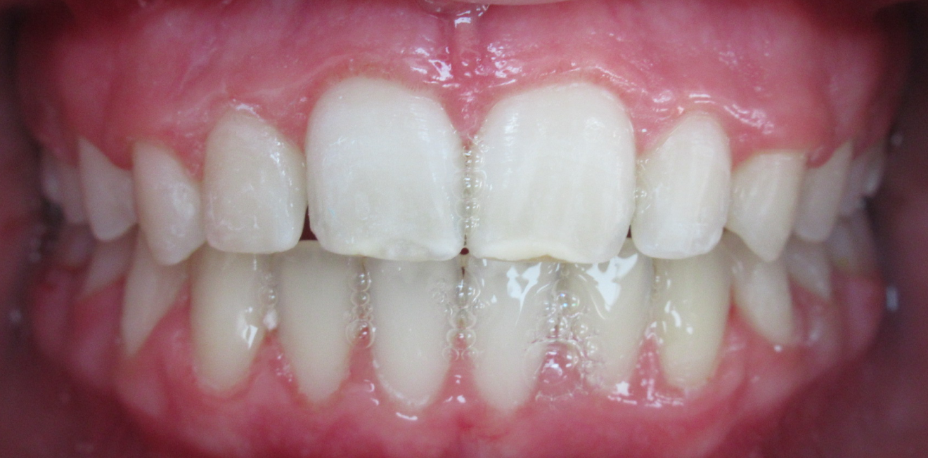 orthodontie interceptive mandelieu la napoule harmonie Cas clinique Dr Mathelin Christel | Orthodontiste Mandelieu-la-Napoule