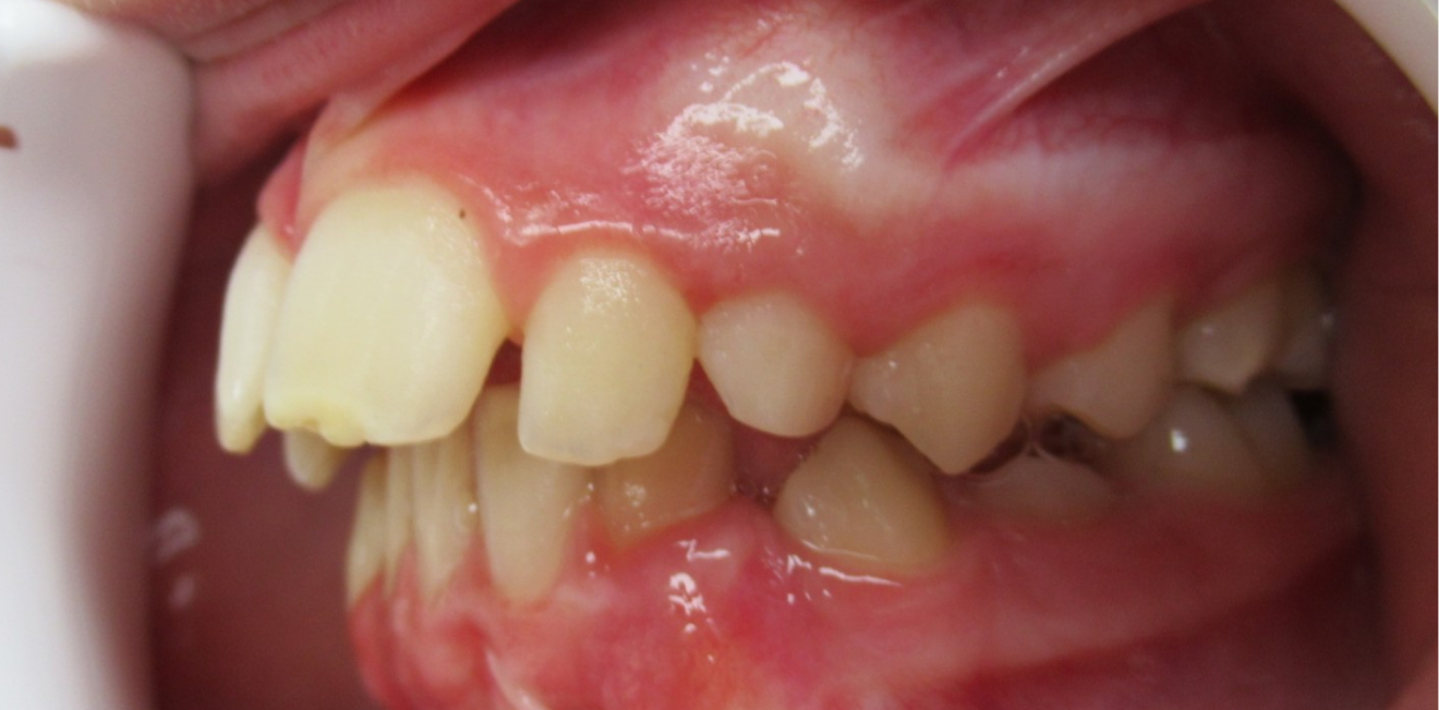 orthodontie interceptive mandelieu la napoule prevention Cas clinique Dr Mathelin Christel | Orthodontiste Mandelieu-la-Napoule