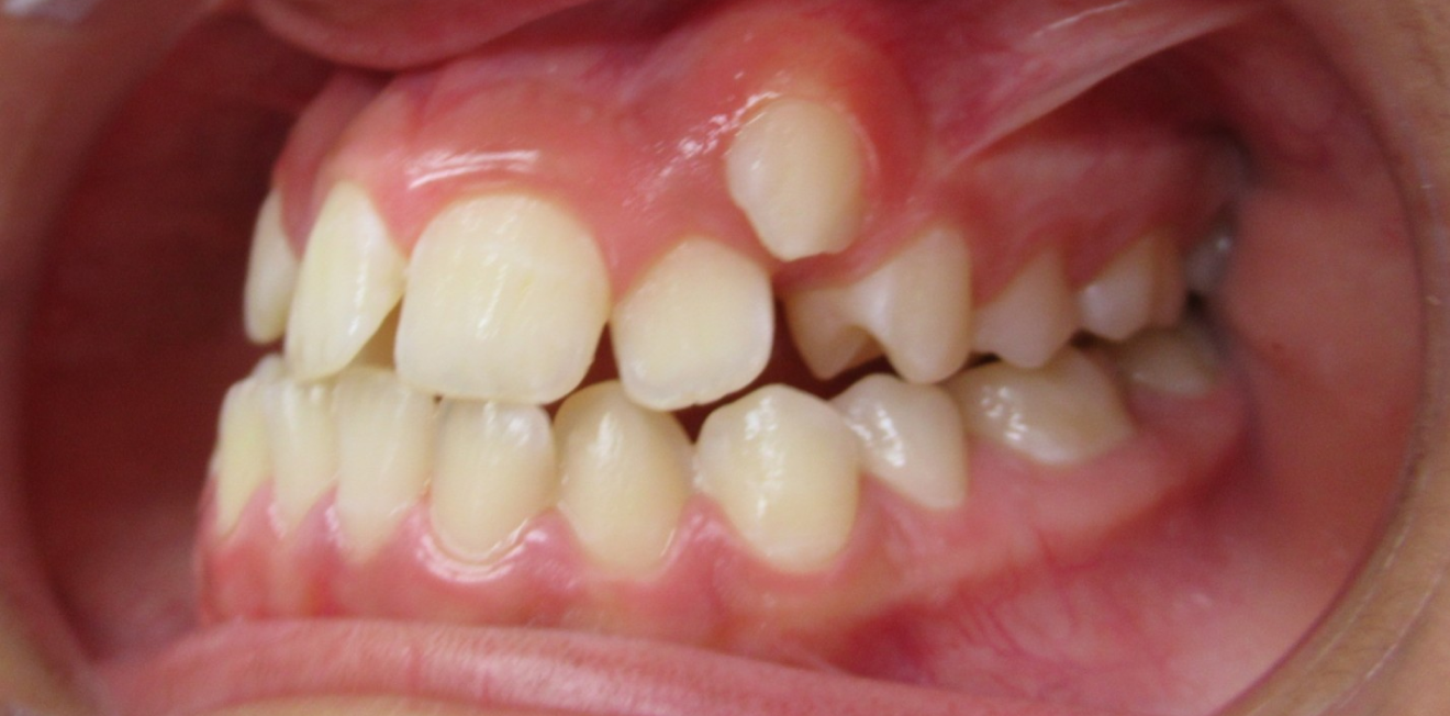 orthodontie interceptive mandelieu la napoule stabilite Cas clinique Dr Mathelin Christel | Orthodontiste Mandelieu-la-Napoule