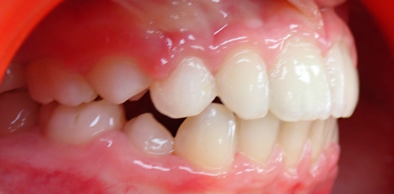 orthodontie interceptive mandelieu la napoule suivi Cas clinique Dr Mathelin Christel | Orthodontiste Mandelieu-la-Napoule