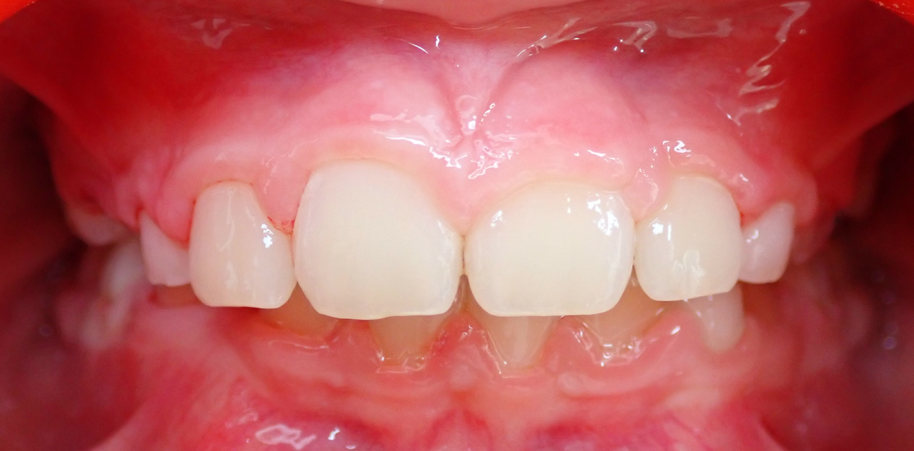 orthodontie mandelieu la napoule correction Cas clinique Dr Mathelin Christel | Orthodontiste Mandelieu-la-Napoule