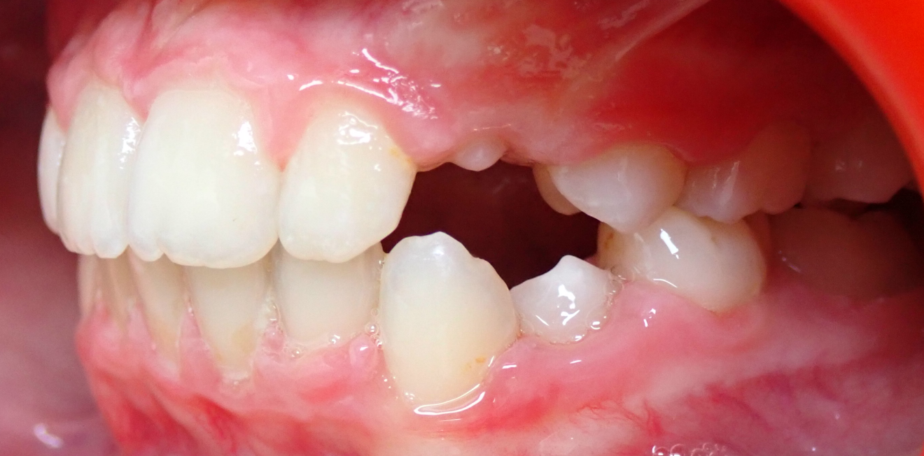 beillon Cas clinique Dr Mathelin Christel | Orthodontiste Mandelieu-la-Napoule