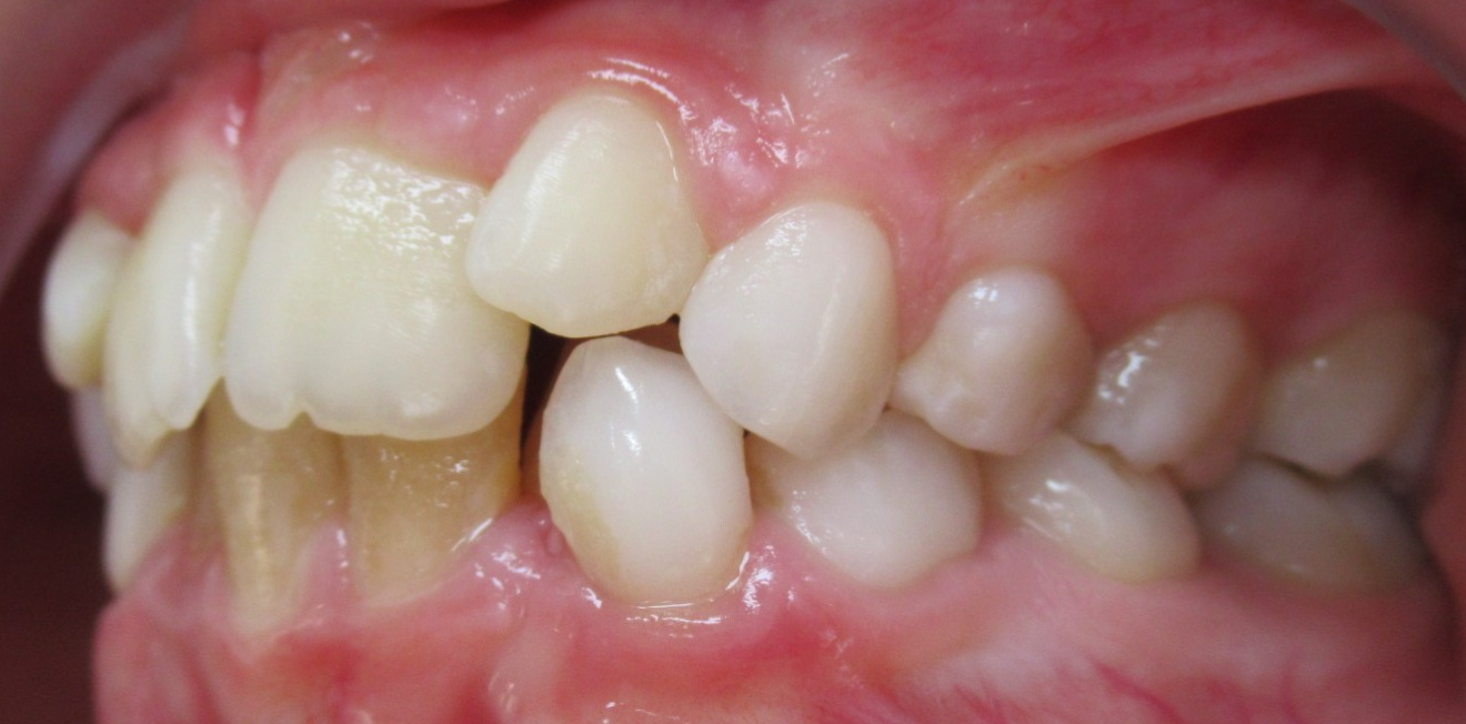 dentisre Cas clinique Dr Mathelin Christel | Orthodontiste Mandelieu-la-Napoule