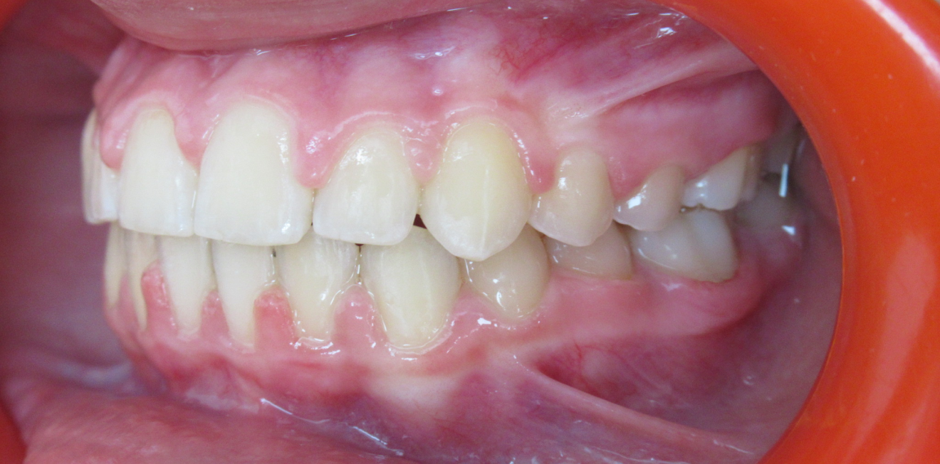 orthodontiste mandelieu la napoule correction maxillaire Cas clinique Dr Mathelin Christel | Orthodontiste Mandelieu-la-Napoule