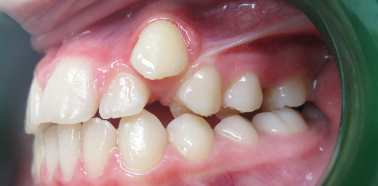 orthodontiste mandelieu la napoule solutions modernes Cas clinique Dr Mathelin Christel | Orthodontiste Mandelieu-la-Napoule